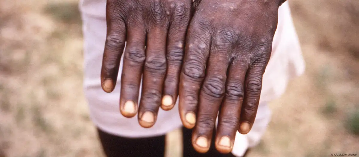 Mpox outbreak declared a public health emergency in Africa