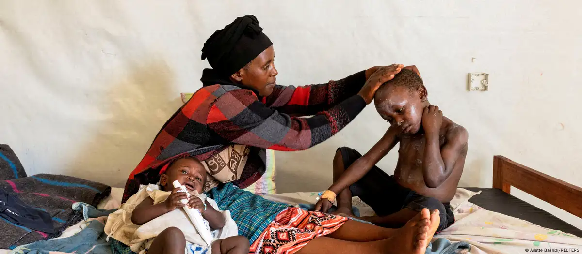 Mpox doses to start to arrive in Congo