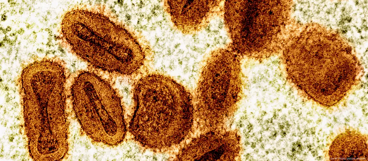 Germany detects first mpox variant Ib case