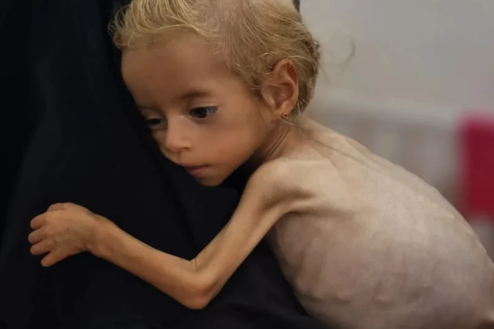 Gaza health ministry reports 100 children dead from malnutrition amid ongoing crisis